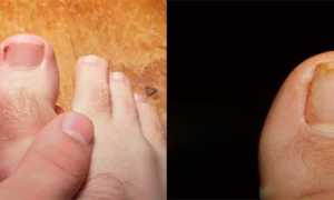 Болит палец на ноге около ногтя: что это может быть и как лечить