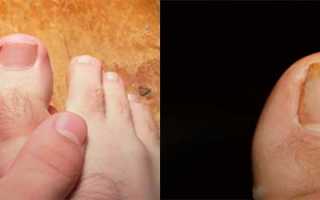 Болит палец на ноге около ногтя: что это может быть и как лечить