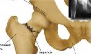Перелом тазобедренного сустава — причины, лечение и симптомы