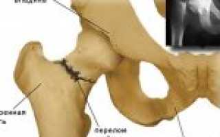 Перелом тазобедренного сустава — причины, лечение и симптомы