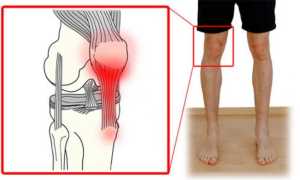 Полная характеристика воспаления связок коленного сустава: симптомы и лечение