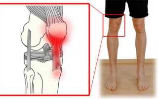 Полная характеристика воспаления связок коленного сустава: симптомы и лечение