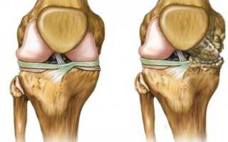 Что такое остеохондроз коленного сустава, какие степени бывают и как проходит лечение?