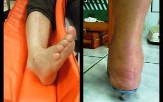 Болят щиколотки ног: причины и последствия этого симптома. Как лечить сильную боль в щиколотках ног: советы врача — Автор Екатерина Данилова