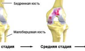 Как лечить артроз коленного сустава 2 степени у врачей