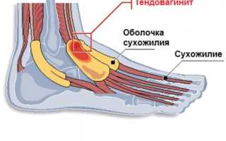 Теносиновит полуперепончатой мышцы коленного сустава лечение. Теносиновит сухожилия длинной головки бицепса: причины