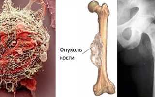Саркома бедренной кости: симптомы, фото, причины, стадии, диагностика, лечение и прогноз
