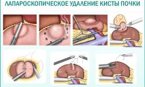 Обзор методов удаления почечных кист