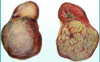Условия формирования и виды лечения почечного фиброза
