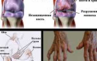 Полиостеоартроз суставов: основные способы лечения