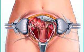 Проблема недержания мочи у женщин после гистерэктомии