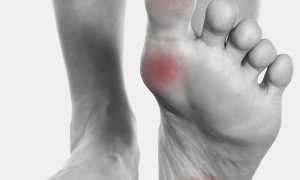 Болит сустав большого пальца на ноге: причины и лечение