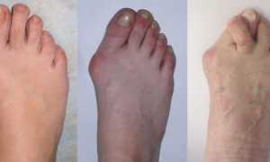 Симптоматика артрита пальцев ног, лечение болезни методами традиционной терапии