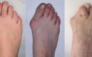 Симптоматика артрита пальцев ног, лечение болезни методами традиционной терапии
