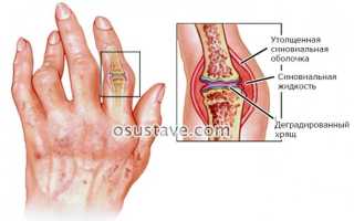 Почему опухают пальцы рук: причины, диагностика и лечение отеков
