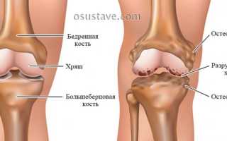Какие физиопроцедуры применяют при артрозе коленного сустава, их результативность