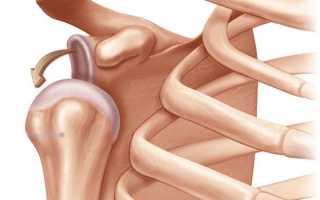 Хроническая нестабильность: когда выскакивает плечевой сустав