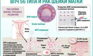 Вирус папилломы человека 56 типа: последствия и лечение